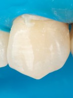 REPORTAŻ KLINICZNY. Bezpośrednie wypełnienia kompozytowe według koncepcji 