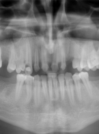 OPIS PRZYPADKU. Martwicze zapalenie przyzębia z wydzieleniem martwiaka kostnego - opis przypadku