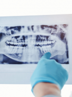 OPIS PRZYPADKU. Leczenie endodontyczne a resorpcja z ucisku