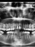 Typowe powikłania w mikrochirurgii endodontycznej- ponowne leczenie z zastosowaniem dwufazowego siarczanu wapnia – opis przypadku