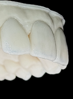 Zastosowanie pośrednich licówek kompozytowych Grandio Disc w technologi CAD/CAM w leczeniu odtwórczym no-prep u pacjentów po leczeniu ortodontycznym – opis przypadku