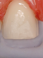 PROTOKÓŁ POSTĘPOWANIA. Preparacja zęba do licówki ceramicznej – Christopher C. K. Ho
