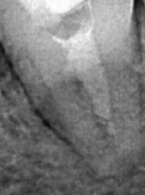 EDUKACJA. A Rare Case of Orthograde Retrieval of Extruded Instrument following Periapical Tissue Healing – Case Report – Ahmed Elhakim, Tarek Mohamed Abd El-Wahan
