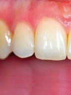 Minimalnie inwazyjna poprawa estetyki zębów siecznych szczęki za pomocą materiału złożonego