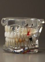 Idealne leczenie endodontyczne – a co dalej ? Odbudowy po leczeniu endodontycznym