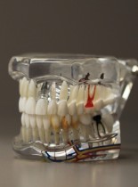 Idealne leczenie endodontyczne – a co dalej ? Odbudowy po leczeniu endodontycznym